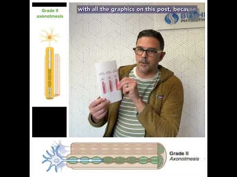 Axonotmesis: what you can expect in your facial paralysis with this type of injury....