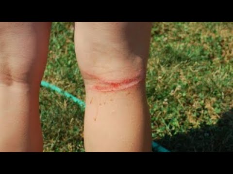 Flexi leash fails - why you should not be using a retractable leash