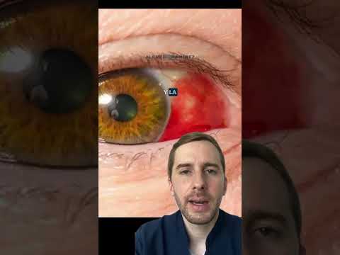 ¿Sangre en el ojo? Hemorragia subconjuntival cirujano oftalmólogo Alfredo Ramírez de Cartagena