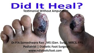 #GangreneToe #InfectedToe  diabetes foot case