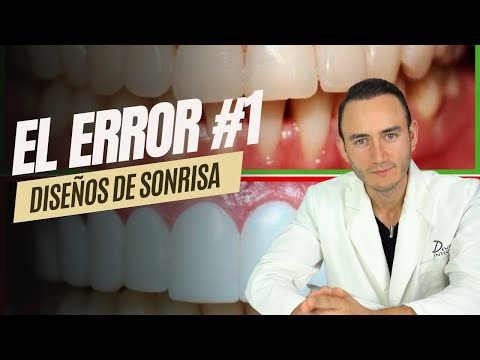 El error #1 en un Diseño de Sonrisa