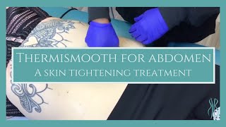 ThermiSmooth Of The Abdomen
