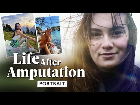 Serious traffic accident: everyday life with a prosthetic leg