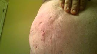 Hidradenitis Suppurativa Leakage