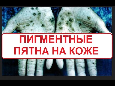 Мужчина с нормальной пигментацией кожи и толстыми губами вступил в брак Как избавится от веснушки зубной пастой