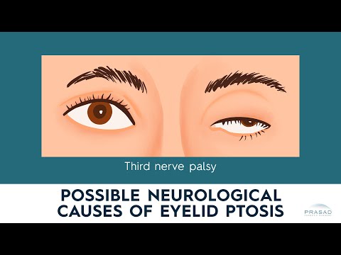 Neurological Causes of Ptosis: Myasthenia Gravis, Horner's Syndrome, and Third Nerve Palsy