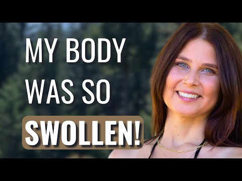 My RARE Cancer Misdiagnosed as Allergies! - Melinda | Adrenocortical Carcinoma | The Patient Story