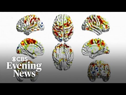 How smartphone addiction may be hurting our brains