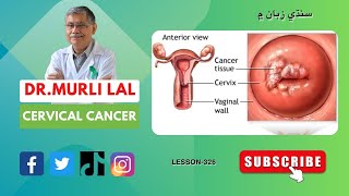 Cancer Cervix |#Cancer | #HPV #Vaccine | Dr. Murli Lal ڪينسر #سروڪس جو ڪينسر #ويڪسين نچائيندي#