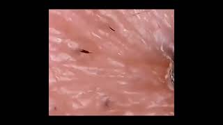 Blackhead Satisfyingly Removed 😍 #shorts