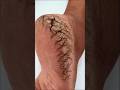 Cracked Feet In 1 Day Home Remedy For Crack Heels Get Soft Fair Feet Shorts Crackedheels