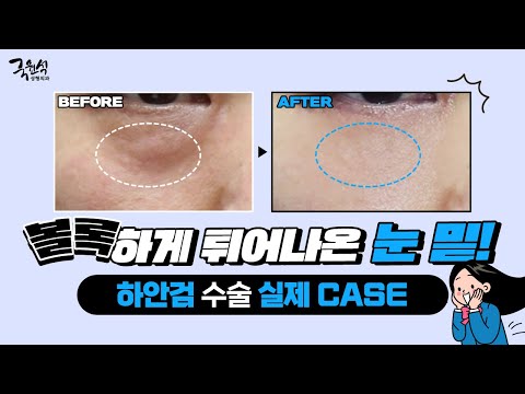 하안검 수술 실제 CASE! 튀어나온 눈 밑, 확실하게 개선하는 방법은?!