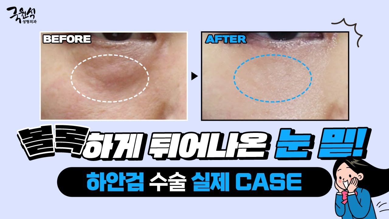하안검 수술 실제 CASE! 튀어나온 눈 밑, 확실하게 개선하는 방법은?!