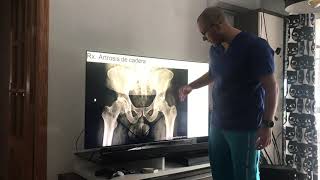 Rx. Artrosis de cadera