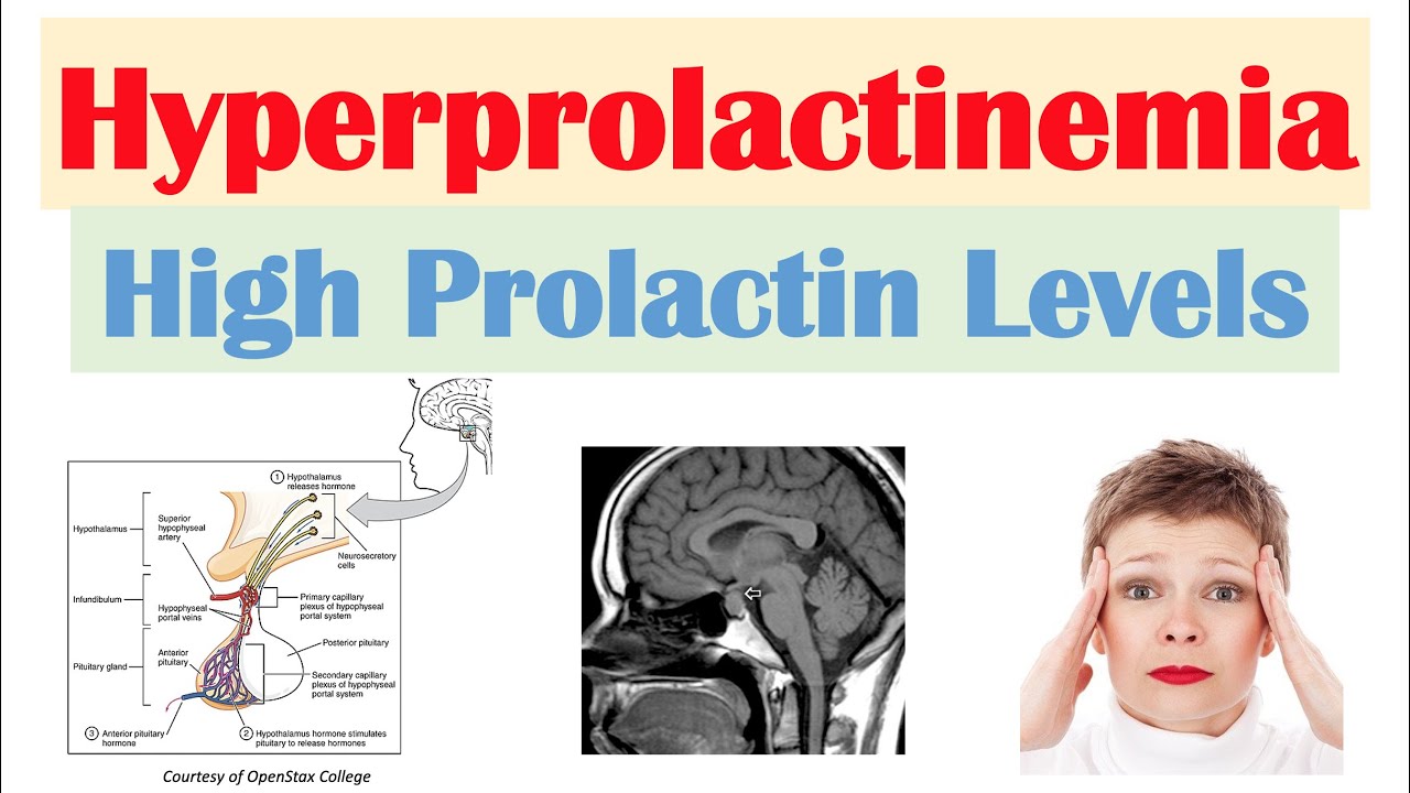 Hyperprolactinemia (High Prolactin Levels) | Causes, Signs & Symptoms, Diagnosis, Treatment