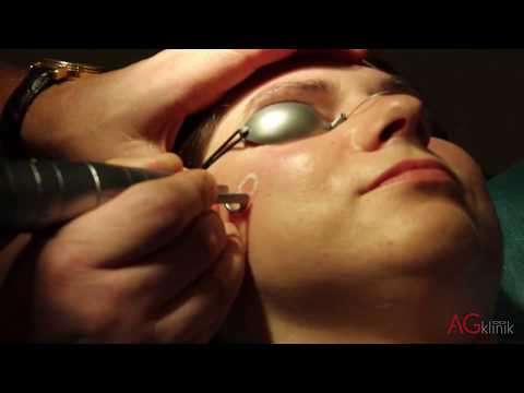 Laserowe usuwanie przebarwień w AGKlinik