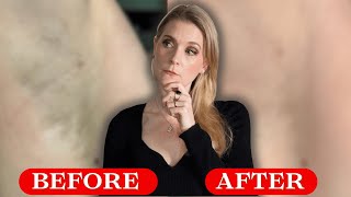 CurrentBody Laser Hair Removal Review: 6 Months Results & Treatment Tips | Doctor Anne
