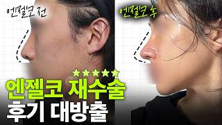 엔젤코 경과 대방출 2탄✨엔젤코 찐 수술 후기 모음! 이번엔 재수술 후기 공개합니다!
