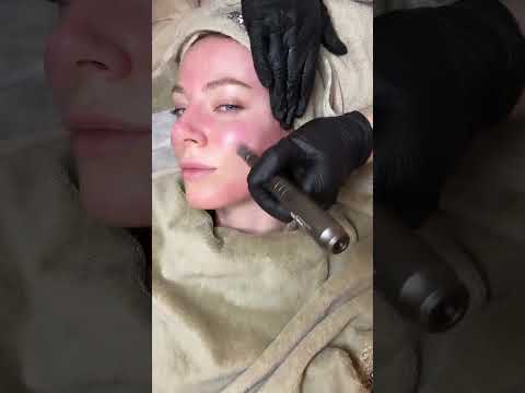 Scopri il Microneedling con i Sieri Biologique Recherche: Il Trattamento Esclusivo di Yanabeauté