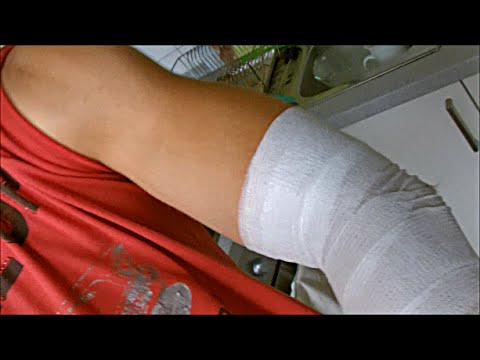 Als behandelte Synovitis des Sprunggelenks Durch Schmerzen in den Gelenken unterbrochen