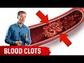 How To Know If You Have A Blood Clot