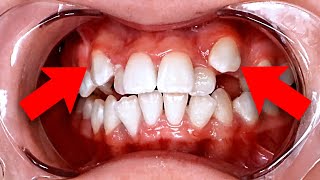 What to do if your Permanent Teeth ARE NOT Coming in...Treatment Options