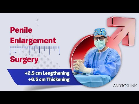 Penile Enlargement Surgery (+2.5 cm lengthening, +6.5 cm thickening) 