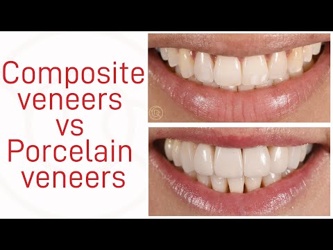 Composite veneers vs Porcelain veneers