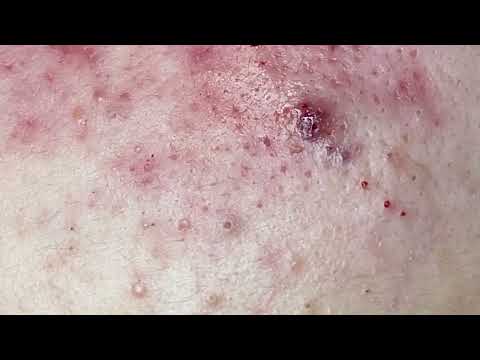 NASA SPA BEST ACNE BLACKHEADS TREATMENT #588986668983