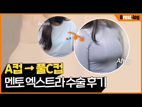 가슴 성형외과 고르는 꿀팁 | 1인 병원 | 가슴 확대 수술 A컵에서 풀 C컵 찐후기 | 윈느성형외과 라벨윈느 유튜브 영상