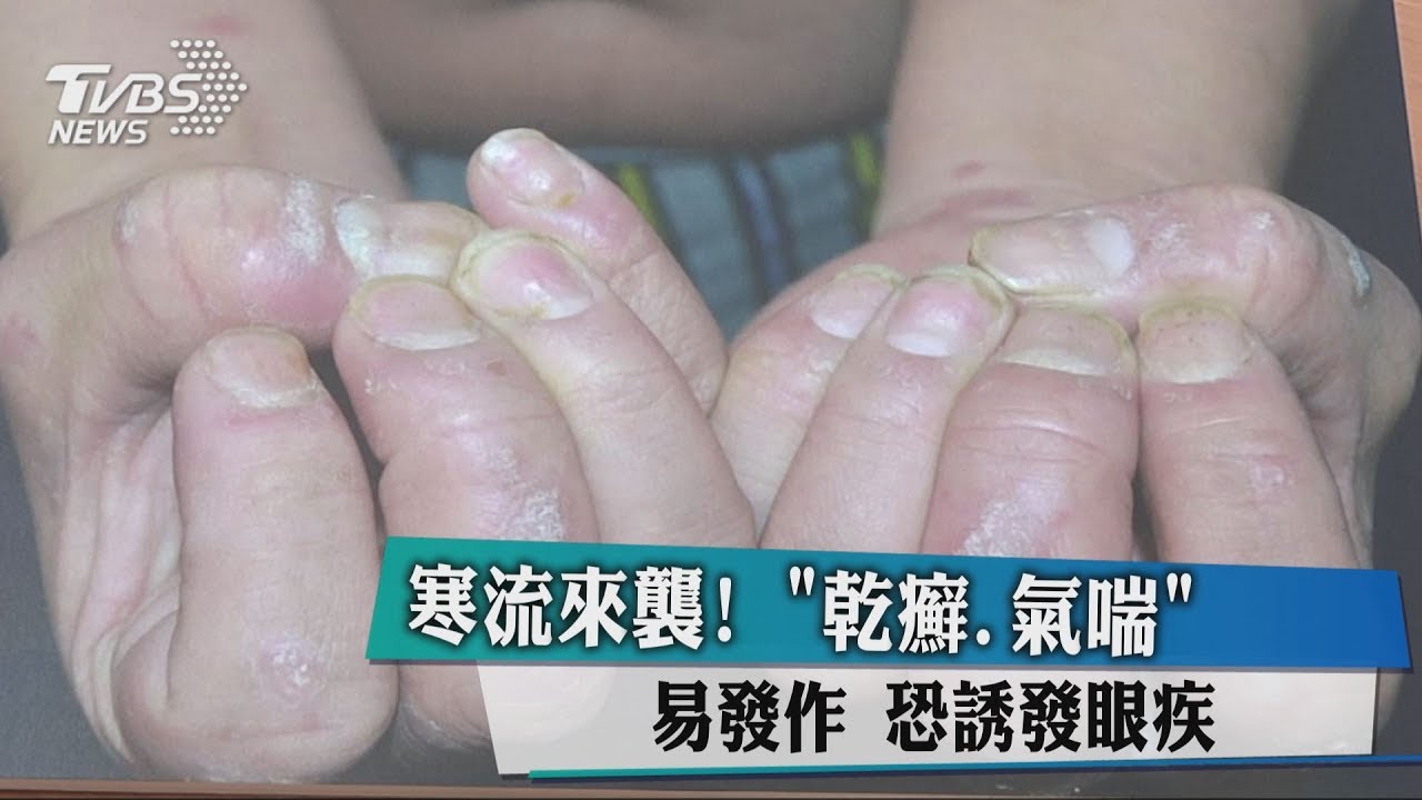 寒流來襲!「乾癬、氣喘」易發作 恐誘發眼疾
