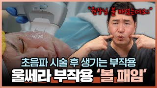 울쎄라 볼패임!! 성형외과 전문의가 알려주는 진짜 원인과 100% 해결/예방법!