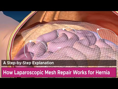 Healthium Trulene Macropore Hernia Mesh