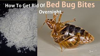 How to Treat Bed Bug Bites - how to get rid of bed bug bites overnight