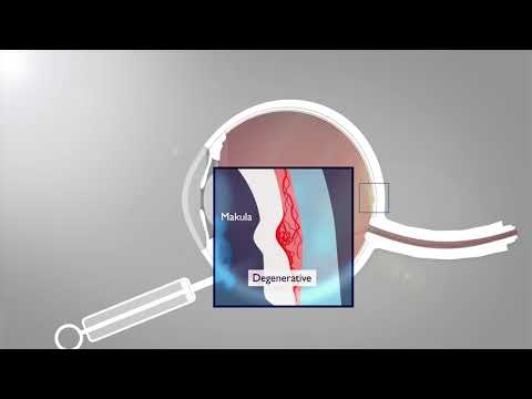 Entstehung und Behandlung der Makuladegeneration/AMD (Animation)