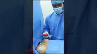 Lipo Transferencia de mamas