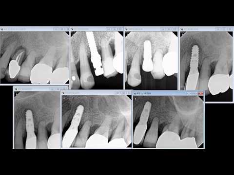Retrograde peri implantitis - Wheaton dentist
