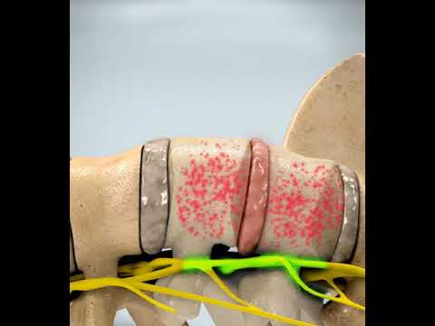 Decompression Lumbar