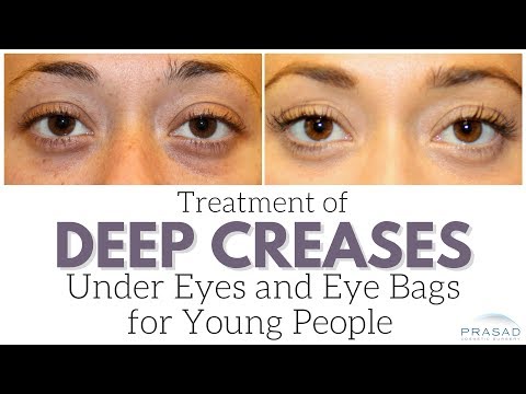deep wrinkles under eyes