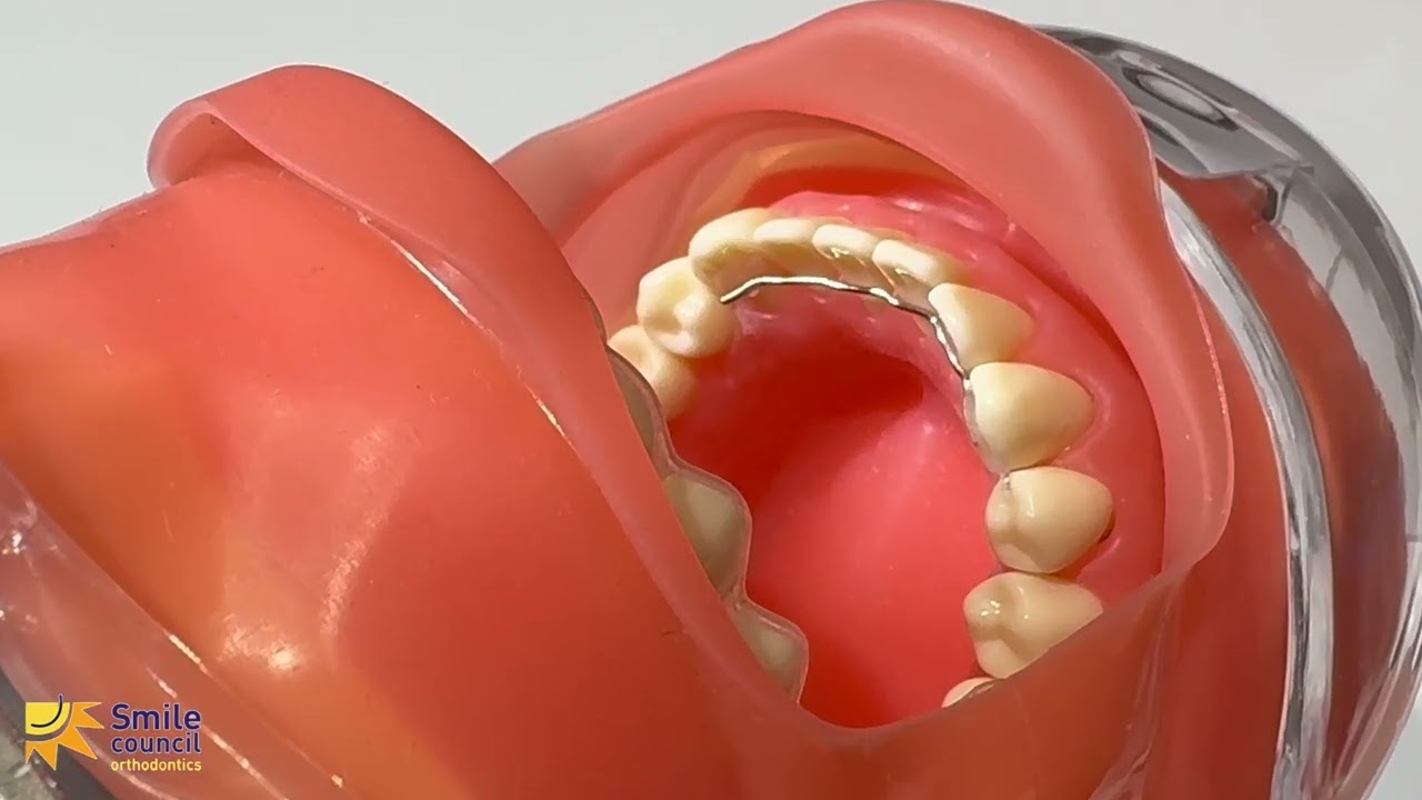 Bonded Retainers