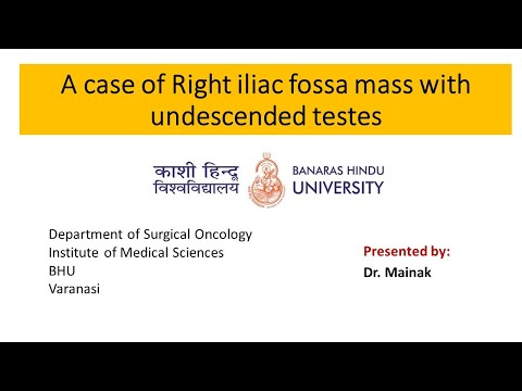 A case of right iliac fossa mass with undescended testes and bony lesion in sternum