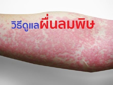 เป็นความลาดชันของโรคสะเก็ดเงินกองทัพ ชีวภาพรักษาโรคสะเก็ดเงิน