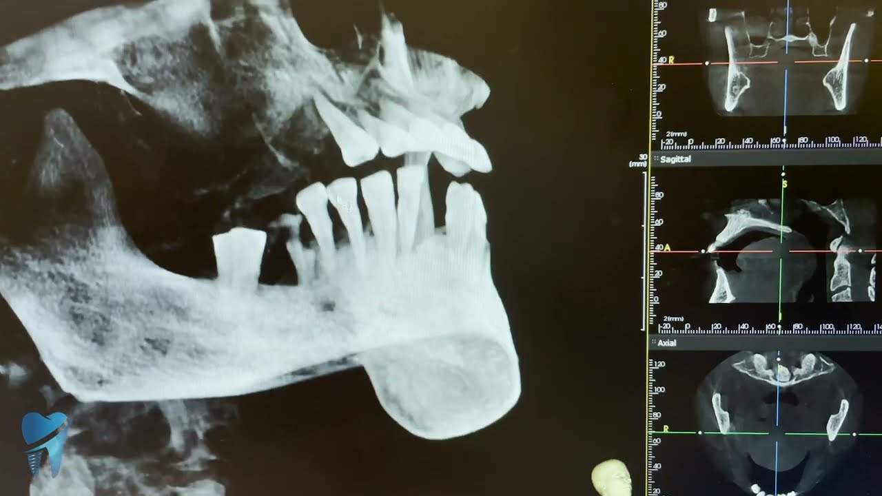 How to place an implant in a mouth? What is All on 4 and all on 6 technics?