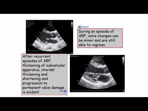 Dr. Ahmed Shawky Elserafy, M.D,   Infective Endocarditis - Rheumatic fever