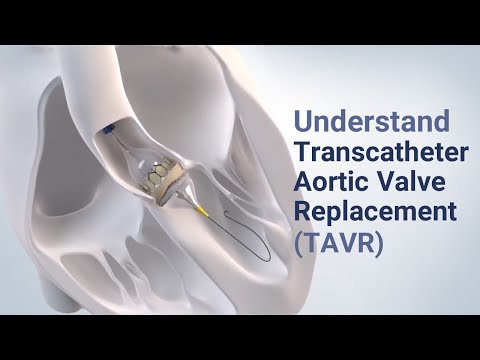 Understand Transcatheter Aortic Valve Replacement (TAVR) - See the Procedure