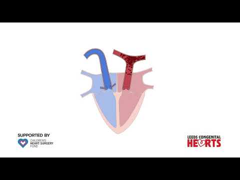 Transposition of the Great Arteries