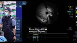 Staged PCI of Calcified Tortuous LM & LAD