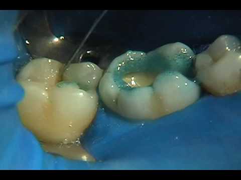 Ionosit Baseliner Ионосит Активный DMG светоотверждаемый однокомпонентный прокладочный материал для полостей - фото 1 - id-p12377736