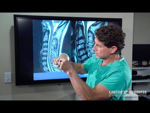 What is Cervical Stenosis? Causes, Symptoms, and Surgical Options for Neck Pain Relief