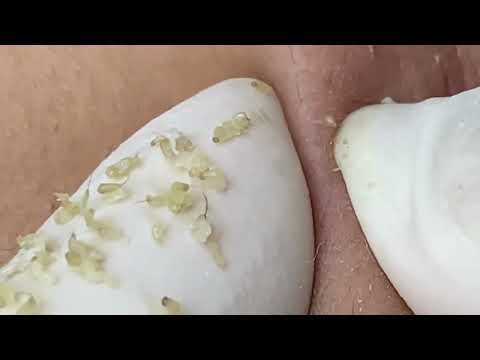 Extreme Blackhead Extraction * ASMR Relaxation *